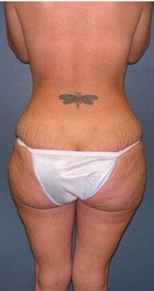 Before Image: Mommy Makeover: Case 1 - back
