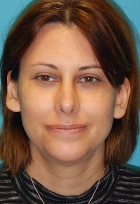 After Image: Chin Augmentation: Case 1 - front