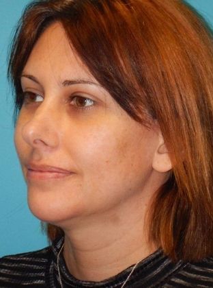 After Image: Chin Augmentation: Case 1 - left-front-oblique