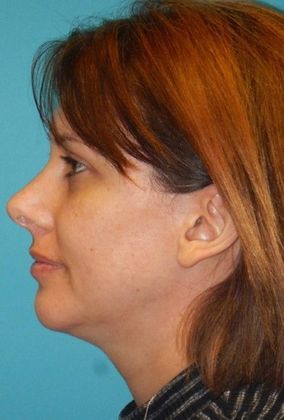 After Image: Chin Augmentation: Case 1 - left-side