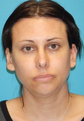 Before Image: Chin Augmentation: Case 1 - front