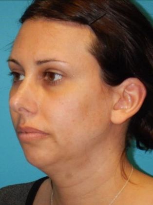 Before Image: Chin Augmentation: Case 1 - left-front-oblique