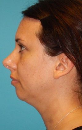 Before Image: Chin Augmentation: Case 1 - left-side