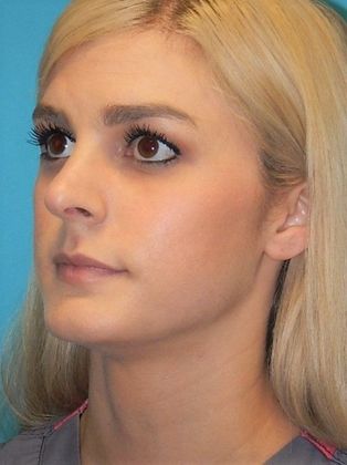 After Image: Soft Tissue Fillers: Case 1 - left-front-oblique
