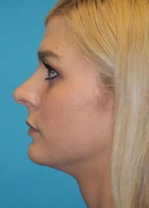 After Image: Soft Tissue Fillers: Case 1 - left-side