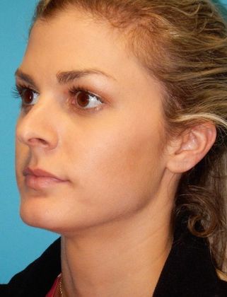 Before Image: Soft Tissue Fillers: Case 1 - left-front-oblique