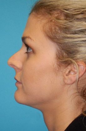 Before Image: Soft Tissue Fillers: Case 1 - left-side
