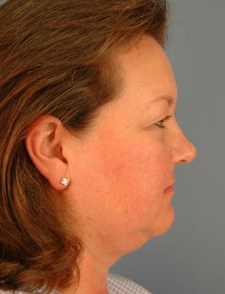Before Image: Liposuction: Case 1 - right-side