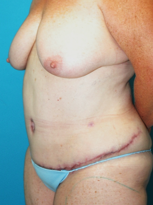 After Image: Abdominoplasty: Case 1 - left-front-oblique