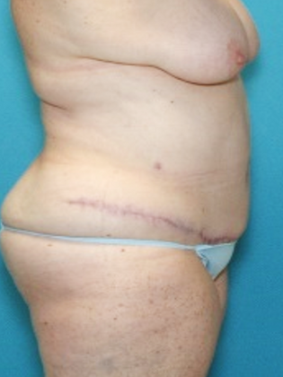 After Image: Abdominoplasty: Case 1 - right-side