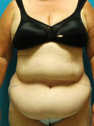 Before Image: Abdominoplasty: Case 1 - front