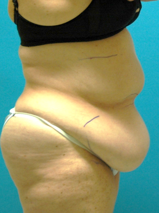 Before Image: Abdominoplasty: Case 1 - right-side