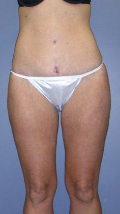 After Image: Thigh Lift: Case 1 - front