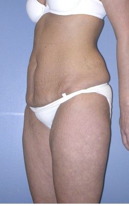 After Image: Thigh Lift: Case 1 - left-front-oblique