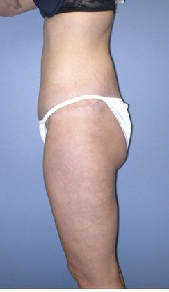 After Image: Thigh Lift: Case 1 - left-side