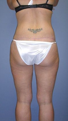 After Image: Thigh Lift: Case 1 - back