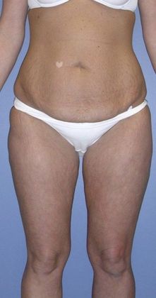 Before Image: Thigh Lift: Case 1 - front