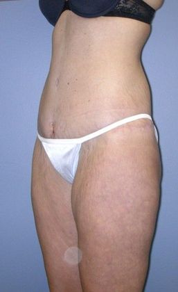 Before Image: Thigh Lift: Case 1 - left-front-oblique
