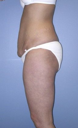 Before Image: Thigh Lift: Case 1 - left-side