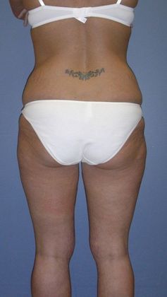 Before Image: Thigh Lift: Case 1 - back