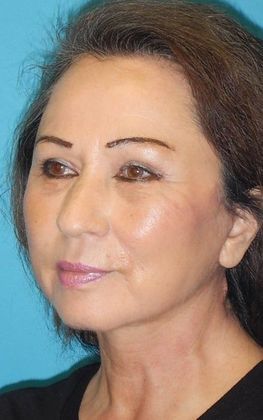After Image: Brow Lift: Case 1 - left-front-oblique