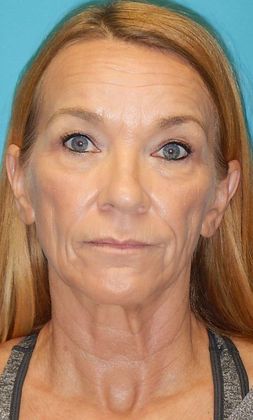 After Image: Laser Skin Resurfacing: Case 1 - front