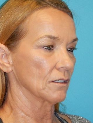 After Image: Laser Skin Resurfacing: Case 1 - right-front-oblique