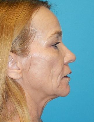 After Image: Laser Skin Resurfacing: Case 1 - right-side