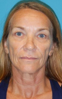 Before Image: Laser Skin Resurfacing: Case 1 - front
