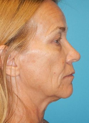 Before Image: Laser Skin Resurfacing: Case 1 - right-side