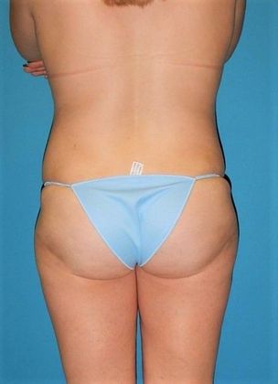 After Image: Brazilian Butt Lift: Case 1 - back