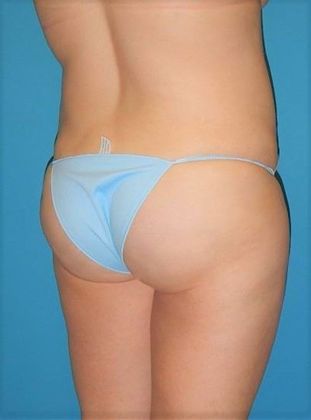 After Image: Brazilian Butt Lift: Case 1 - right-back-oblique