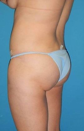 After Image: Brazilian Butt Lift: Case 1 - left-back-oblique