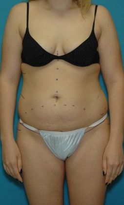 Before Image: Brazilian Butt Lift: Case 1 - front