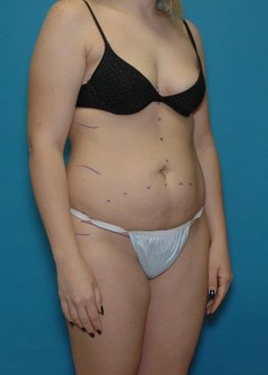Before Image: Brazilian Butt Lift: Case 1 - right-front-oblique