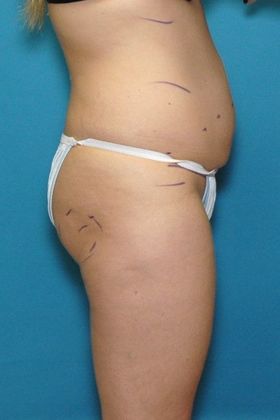Before Image: Brazilian Butt Lift: Case 1 - right-side