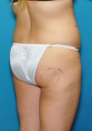 Before Image: Brazilian Butt Lift: Case 1 - right-back-oblique