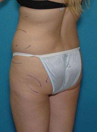 Before Image: Brazilian Butt Lift: Case 1 - left-back-oblique