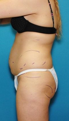 Before Image: Brazilian Butt Lift: Case 1 - left-side