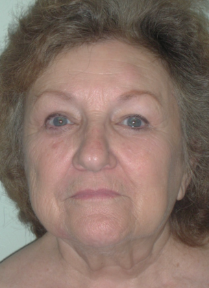 After Image: Eye Lift (Blepharoplasty): Case 1 - front