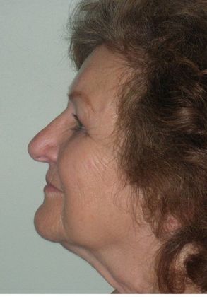 After Image: Eye Lift (Blepharoplasty): Case 1 - left-side