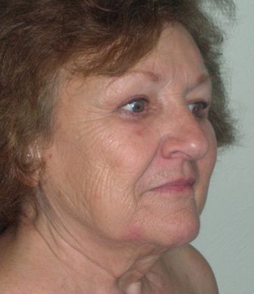 After Image: Eye Lift (Blepharoplasty): Case 1 - right-front-oblique