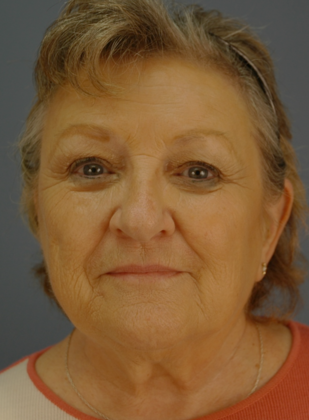 Before Image: Eye Lift (Blepharoplasty): Case 1 - front