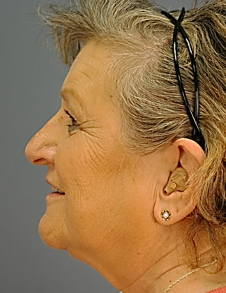 Before Image: Eye Lift (Blepharoplasty): Case 1 - left-side