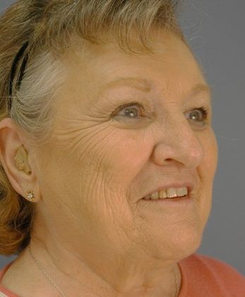 Before Image: Eye Lift (Blepharoplasty): Case 1 - right-front-oblique