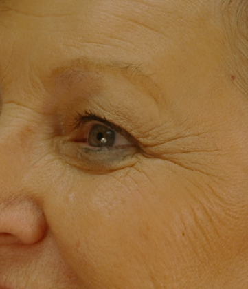 Before Image: Eye Lift (Blepharoplasty): Case 1 - left-front-oblique