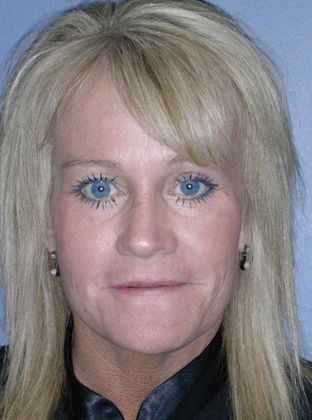 After Image: Fat Grafting Face: Case 1 - front