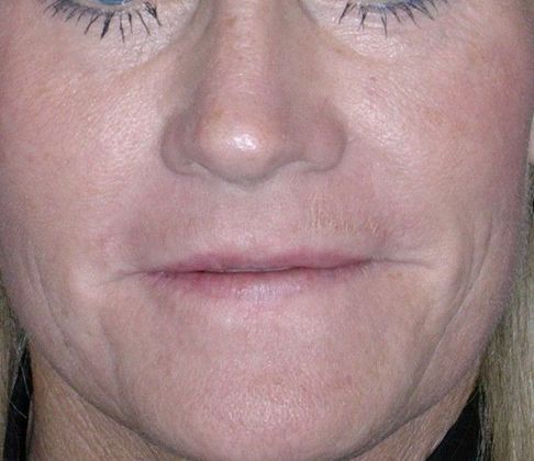 After Image: Fat Grafting Face: Case 1 - front