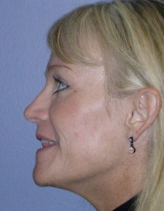 After Image: Fat Grafting Face: Case 1 - left-side