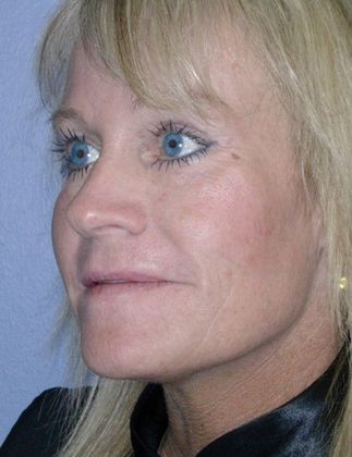 After Image: Fat Grafting Face: Case 1 - left-front-oblique